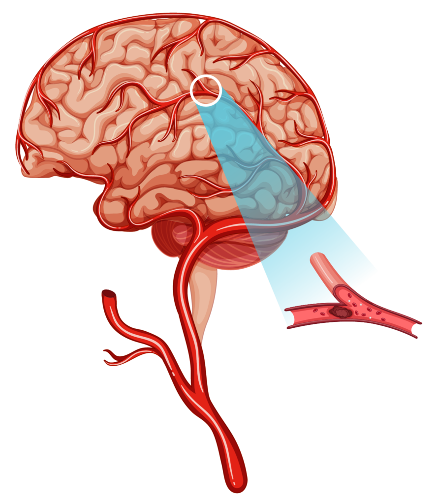 Я буду жить! — Как перенести инсульт и жить дальше